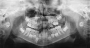 Dental Radiographs (X-Rays) - Pediatric Dentist in Southington, Plainville, Chesire and Bristol, CT