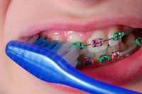 Brushing with braces
