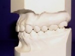 Class 1 Malocclusion
