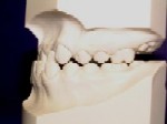 Class 3 Malocclusion