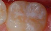 Sealant-After - Pediatric Dentist in Southington, Plainville, Chesire and Bristol, CT